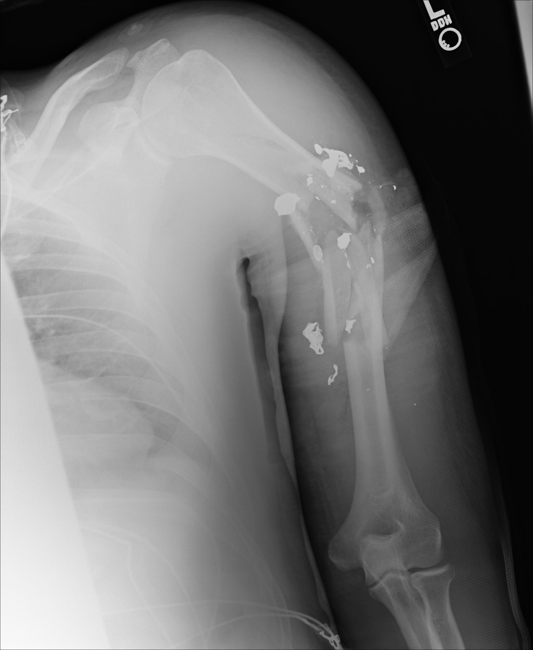 x ray left humerus no rod and frags