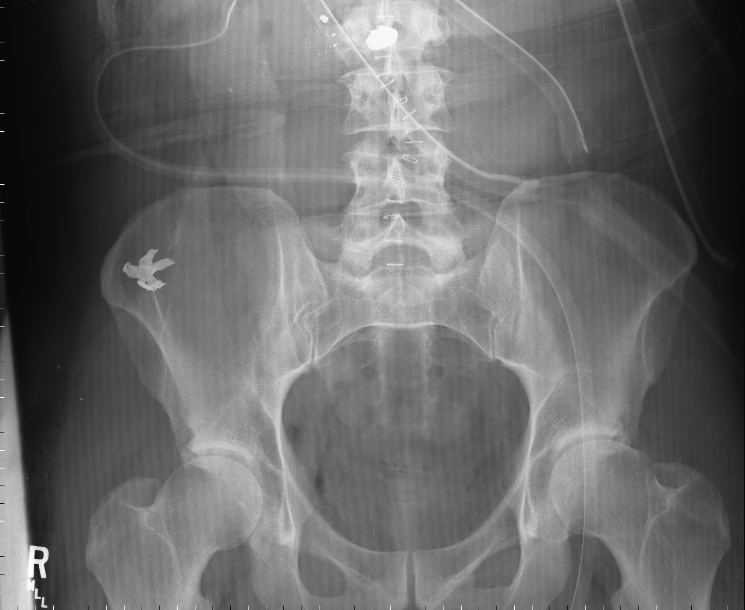 x ray hip shot